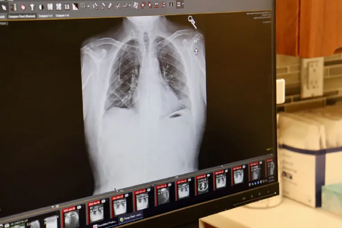 Hình ảnh chụp X-quang lồng ngực bệnh nhân