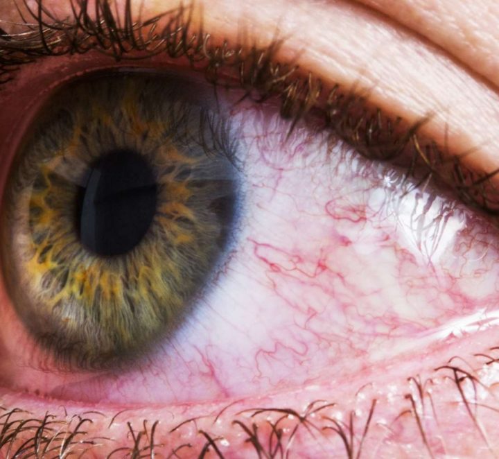 Cảnh báo biến chứng mù lòa do đau mắt đỏ